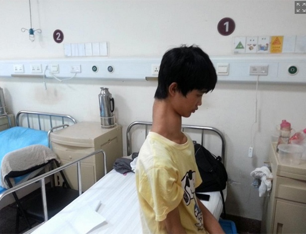 Fu Wengui, 15, sofre de uma condição rara. Ele possui 10 vértebras em seu pescoço, três a mais do que a maioria dos seres humanos - Reprodução/Daily News