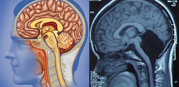 Imagem à esquerda mostra um cérebro comum com cerebelo. O raio-X da direita registra o cérebro da chinesa sem cerebelo - Alex Luengo/ Shutterstock