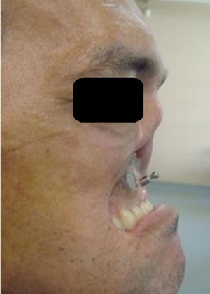 Marcio Palhares fez cirurgia de reconstrução da face - Divulgação/ Departamento de Odontologia Restauradora da UFJF