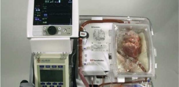 Família acusa equipe médica de utilizar um órgão que já apresentava problemas clínicos - BBC