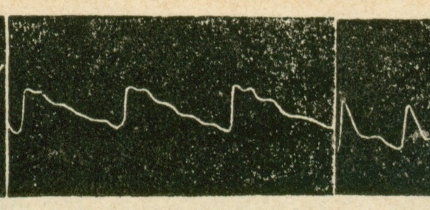 Imagem da gravação do pulso de um francês de 100 anos, realizada em 1869, a partir de um dispositivo do século 19 chamado de "sphygmograph" - Museu Bakken/The New York Times