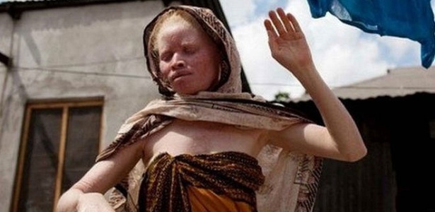Na Tanzânia, pessoas albinas sofrem sequestros e são até assassinadas por sua condição - AFP