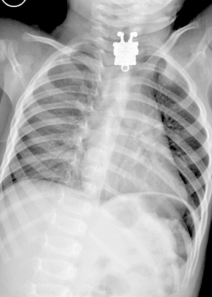 A radiografia de esôfago feita no menino revelou o estranho objeto - Ghofran Ageely/Radiopaedia.org/Cortesia
