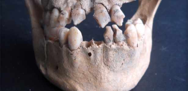 Maxilar e mandíbula de um dos três esqueletos do século 17 da ilha caribenha de St. Martin que apresentam um tipo em comum de modificação dental africana - H. Schroeder et. al/PNAS