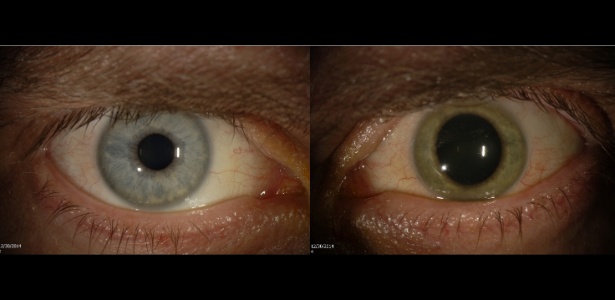 Ebola alterou a cor do olho do dr. Ian Crozier de azul para verde - Emory Eye Center via The New York Times