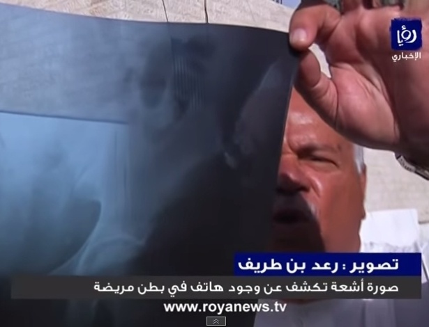 Homem segura raio-X que mostra objeto dentro do abdome  - Royal News/Reprodução