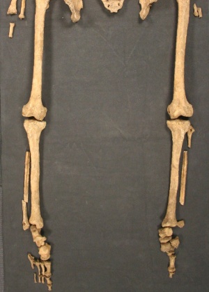 Os cientistas descobriram que os ossos do esqueleto de um homem apresentam alterações compatíveis com a doença, incluindo a diminuição dos ossos dos dedos do pé e danos nas articulações - University of Southampton via The New York Times