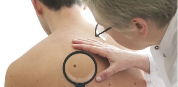 Estudo foi feito com 436 pacientes que tinham melanomas inoperáveis  - Thinkstock