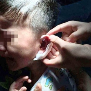 Médico remove o grampo de orelha de aluno - Reprodução/Daily Mail 