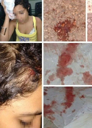 Montagem de fotos com ferimento em menina de 11 anos atingida por pedra na cabeça ao deixar um culto de candomblé na Penha, Rio - Reprodução/Facebook