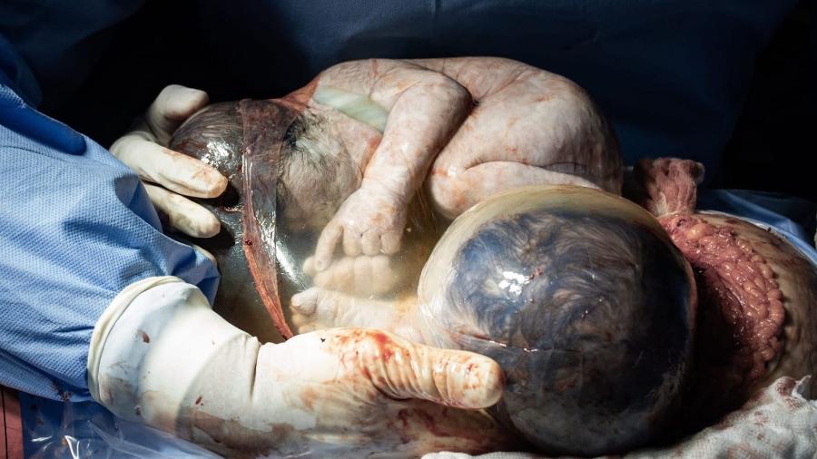 Os gêmeos Théo e Gael nasceram empelicados, um tipo raro de parto com incidência de um caso a cada 80 mil - Arquivo Pessoal/Juliana Pereira