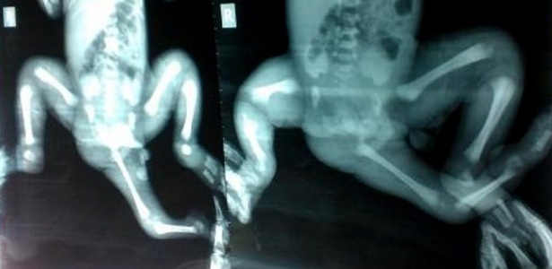 Imagem de raio-x de menina que nasceu com três pernas, uma delas localizada na região do períneo - AFP