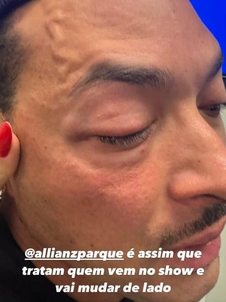 Deputado estadual Felipe Franco (União-SP) mostra olho roxo e diz ter sido agredido por seguranças no show de Chris Brown