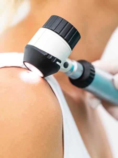 Médico analisando se há presença de melanoma (câncer de pele) em paciente usando um dermatoscópio - Getty Images