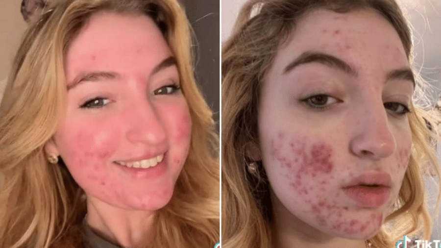 A conta TikTok de Eva Grant foi banida porque sua acne foi rotulada como "horrível" - @porefectionx/TikTok