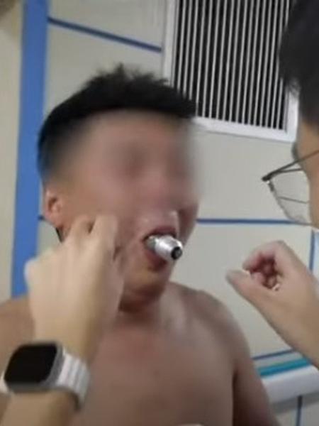 Homem ficou com lâmpada presa na boca após tentar cumprir desafio