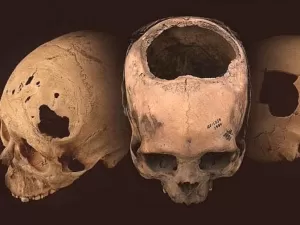 Trepanação: procedimento feito em Lula já foi usado para 'tirar demônios'