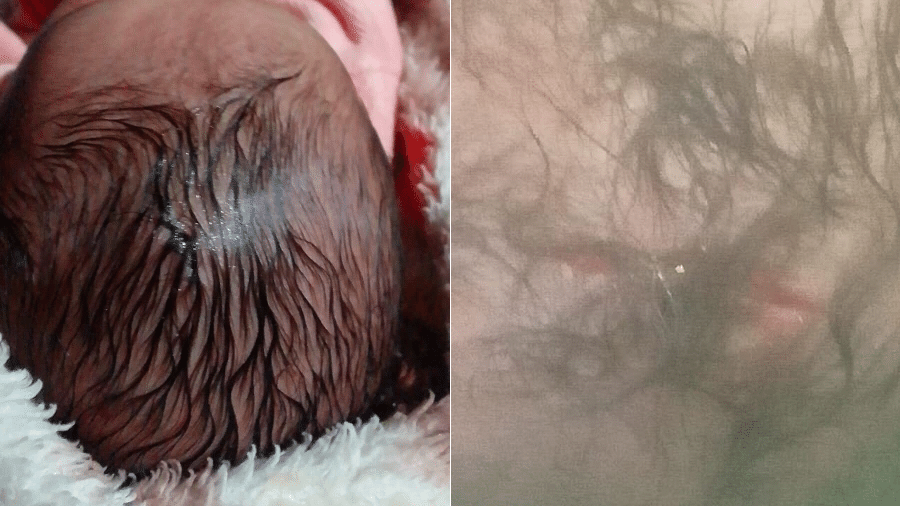 Família de recém-nascida alega que a criança sofreu um corte na cabeça durante parto realizado em SC