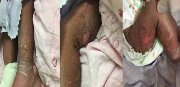 No Ceará, crianças estão sendo internadas com lesões graves na pele, semelhante a queimaduras causadas pelo sol - Sociedade Cearense de Pediatria