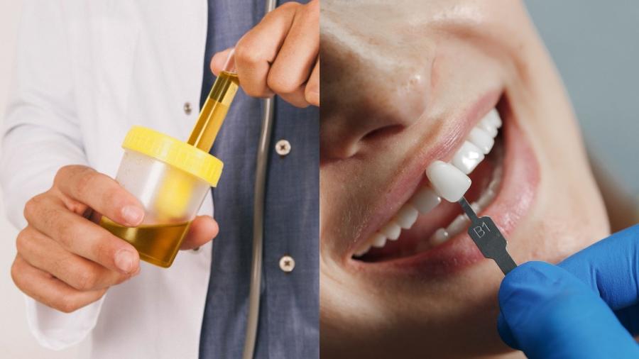 Urina humana pode ser transformada em hidroxiapatita, um mineral resistente encontrado naturalmente nos ossos e dentes