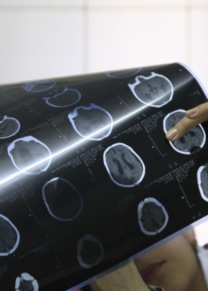 Exame de tomografia de criança com microcefalia - Guga Matos/ JC Imagem/ AE