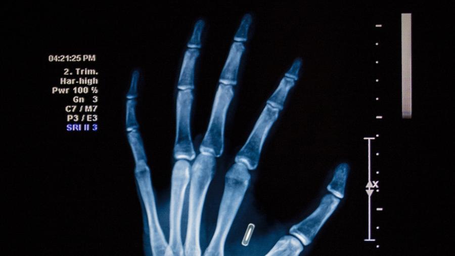 Você implantaria um chip na mão para pagar sem cartão? - Getty Images/iStockphoto