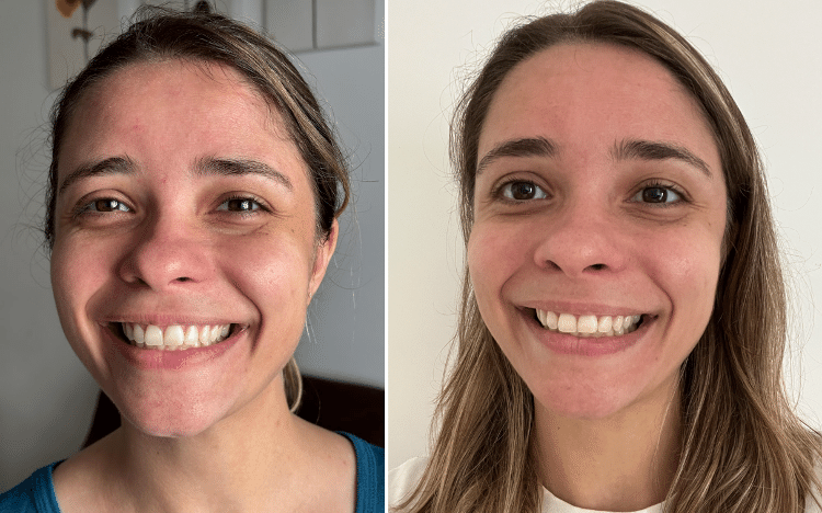 Antes e depois de seis dias de uso do bastão facial Ricca Antes e depois de seis dias de uso do bastão facial Ricca