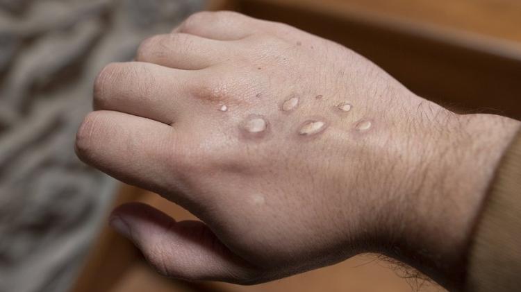 virus - Getty Images - Getty Images