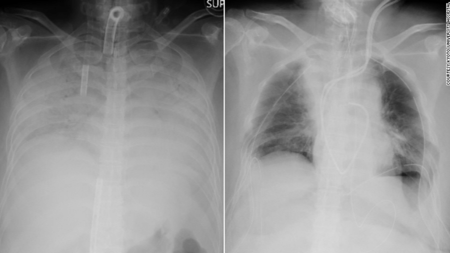 As imagens de raios-x mostram o tórax do paciente antes do transplante, à esquerda, e depois da operação, à direita. As áreas escuras indicam onde o tecido pulmonar foi transplantado - Reprodução/Hospital Universitário de Kyoto 