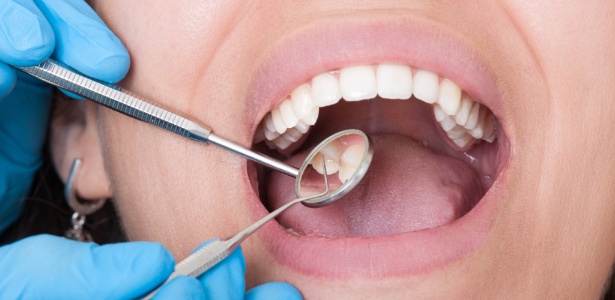 27.abr.2017 - Dentista/ Dente/ Cárie - iStock - iStock