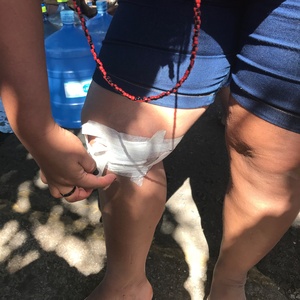 Indígena mostra curativo em ferimento causado por bala de borracha disparada pela PM do DF na frente da Câmara em 22 de junho de 2021 - Rubens Valente/UOL - Rubens Valente/UOL