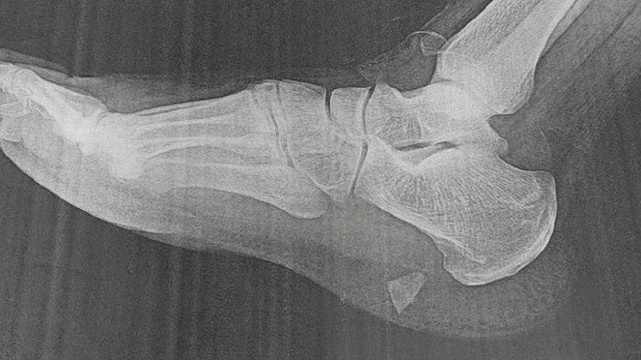Sem conseguir atendimento, homem fica 5 meses com caco de vidro no pé - Arquivo pessoal