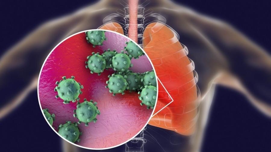 O coronavírus causa doença pulmonar grave - Getty Images