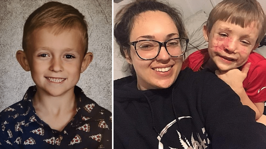 O garoto Camdon Bozbell antes e depois do ataque do pitbull; ele se recupera ao lado da mãe  - Reprodução/Daily Mails