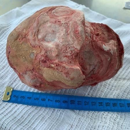 Pedra de 18 cm é retirada de paciente na Bahia - Renan Oliveira Barreto/Divulgação