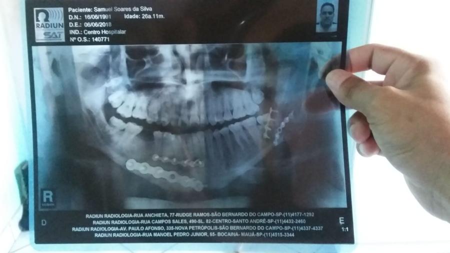Raio-X mostra os 22 pinos utilizados para reconstituir a mandíbula da vítima - Arquivo Pessoal