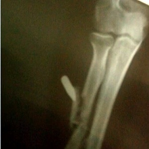 A menina passou por cirurgia para retirar o projétil que ficou alojado no braço - Reprodução/TV Globo