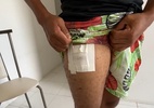 Celular explode em bolso e deixa homem ferido em SE - Reprodução/TV Globo