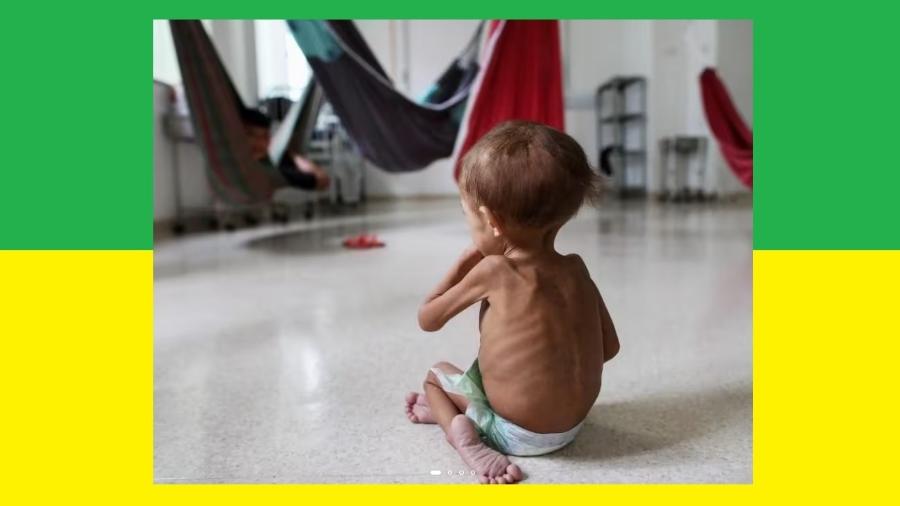 Uma criança yanomami esquálida recebe cuidados médicos no Hospital Infantil Santo Antônio, em Boa Vista. Isso acontece no Brasil! - Michael Dantas/AFP