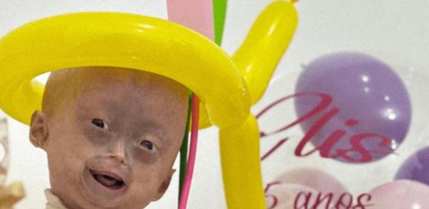 Morre Elis, gêmea com progéria