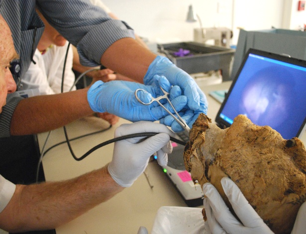 Médicos do Hospital Geral de Massachusetts extraem dente de múmia  - Museum of Fine Arts, Boston via The New York Times