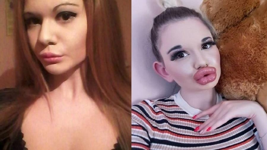 Antes e depois dos procedimentos labiais de Andrea; a jovem começou a aumentar os lábios em 2018 - Reprodução/Instagram/@andrea.andrea345