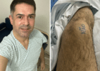 Paciente marca joelho a ser operado para evitar erro em cirurgia no CE - Arquivo Pessoal