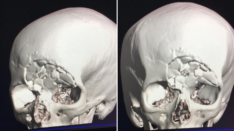 Exame de imagem mostra proporção do impacto no crânio de Michaella