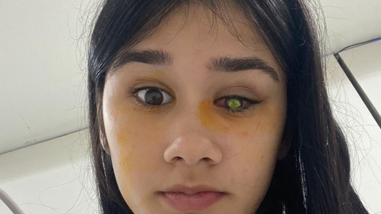 Lara mostra o olho infeccionado
