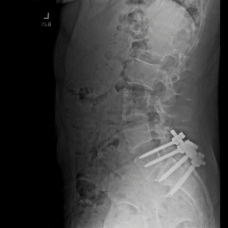 Imagem de radiografia de coluna espinhal publicada por Luigi Mangione