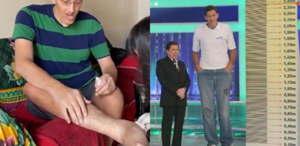 PB: Homem mais alto do Brasil terá perna amputada para conter infecção - Vimarsana News