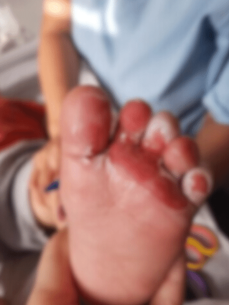 Bebê sofre queimaduras em creche de Santa Catarina - Arquivo pessoal