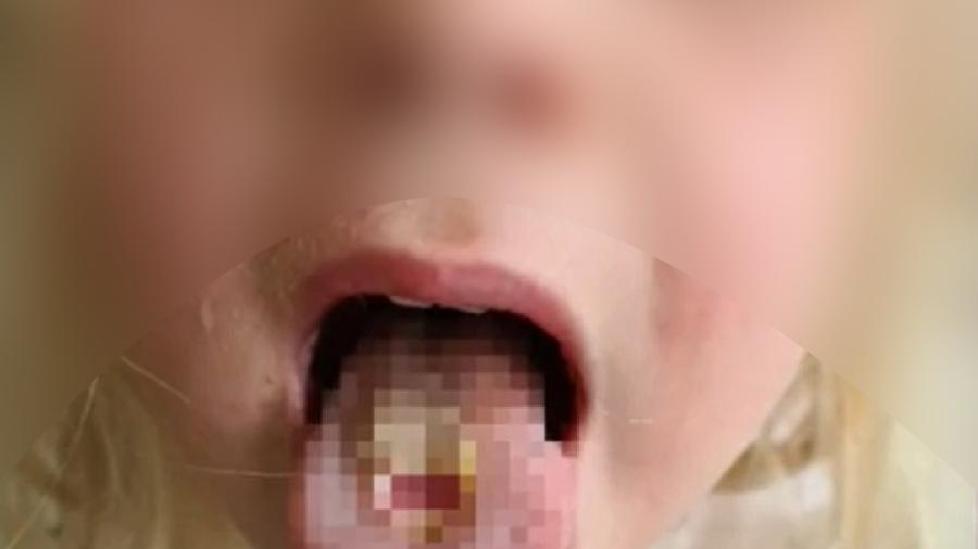 Menina comeu balas ácidas e sofreu queimaduras na língua - Reprodução/9News