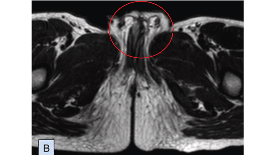 Imagem mostra os dois pênis antes da cirurgia, na região do círculo vermelho - Divulgação/Science Direct
